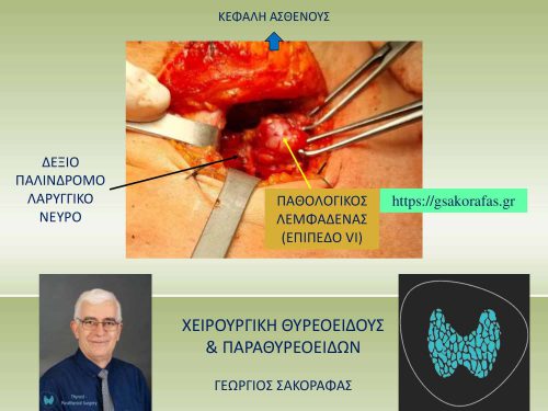 Η πορεία του δεξιού παλίνδρομου λαρυγγικού νεύρου επί του παθολογικού λεμφαδένα του κεντρικού διαμερίσματος μετά την κινητοποίησή του