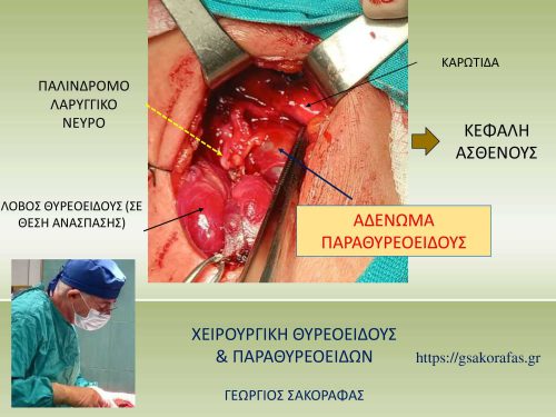 Διεγχειρητικά ευρήματα