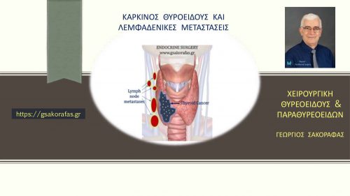 Καρκίνος θυρεοειδούς και μεταστάσεις στους λεμφαδένες του τραχήλου – πώς αναγνωρίζονται?