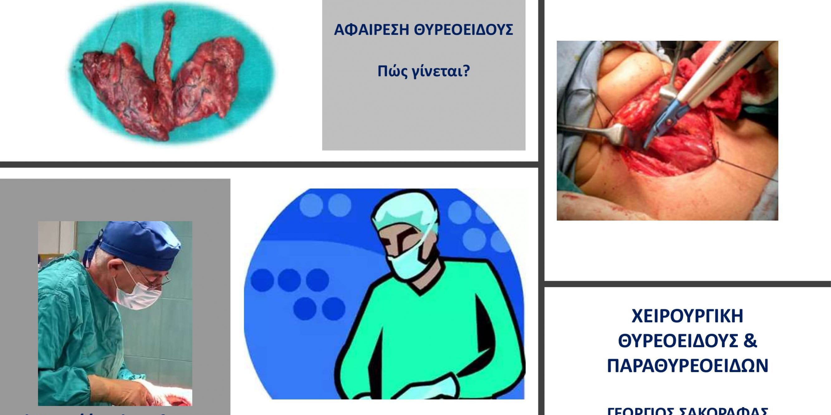 Αφαίρεση θυρεοειδούς – πώς γίνεται η επέμβαση?