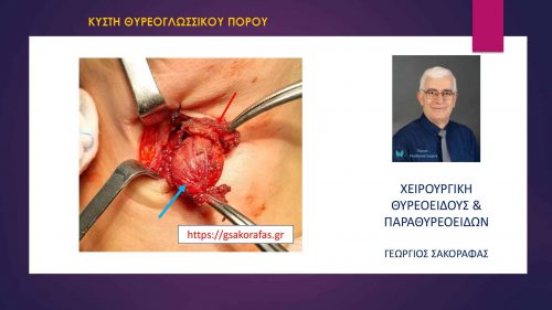 Χειρουργικό παρασκεύασμα - η κύστη με τον κεντρικό τμήμα του υοειδούς οστού