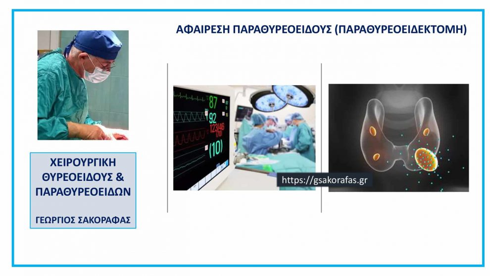 Αφαίρεση παραθυρεοειδούς – παραθυρεοειδεκτομή - πώς γίνεται ? Μέρος Β : ΕΠΕΜΒΑΣΗ
