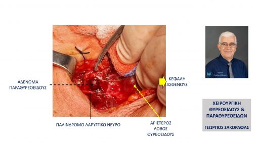 Εικόνα από το χειρουργείο μετά την κινητοποίηση του αδενώματος και τη διατήρηση του λαρυγγικού νεύρου