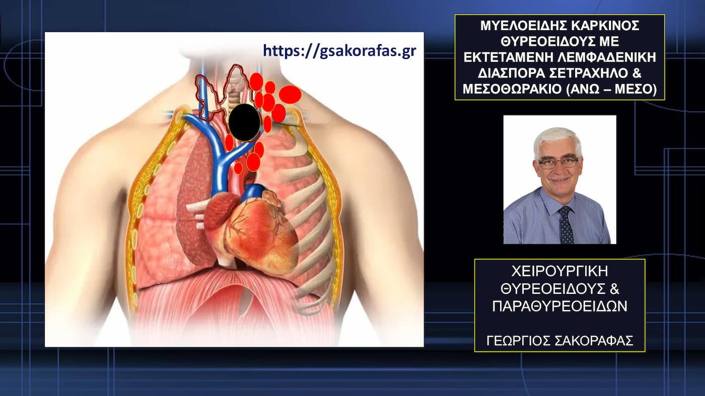 Μυελοειδής καρκίνος θυρεοειδούς με εκτεταμένη λεμφαδενική διασπορά στον τράχηλο και στο μεσοθωράκιο