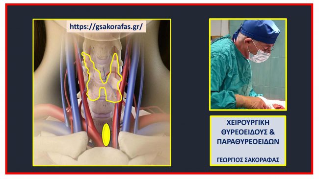 Έκτοπο αδένωμα παραθυρεοειδούς 9 0 6