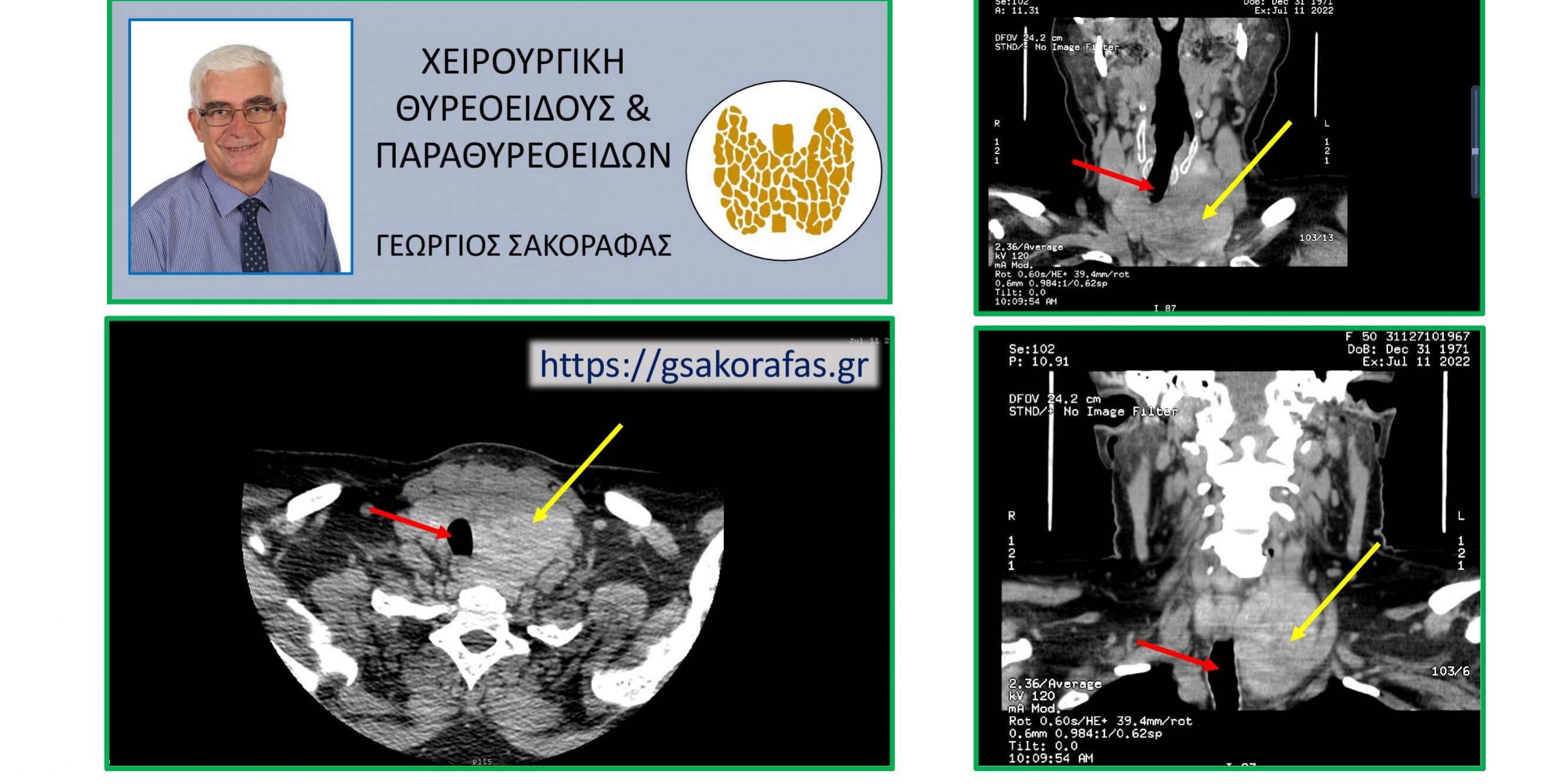 Βρογχοκήλη λίαν ευμεγέθης σε ασθενή μας - εικόνες από την αξονική τομογραφία (βλ. κείμενο)