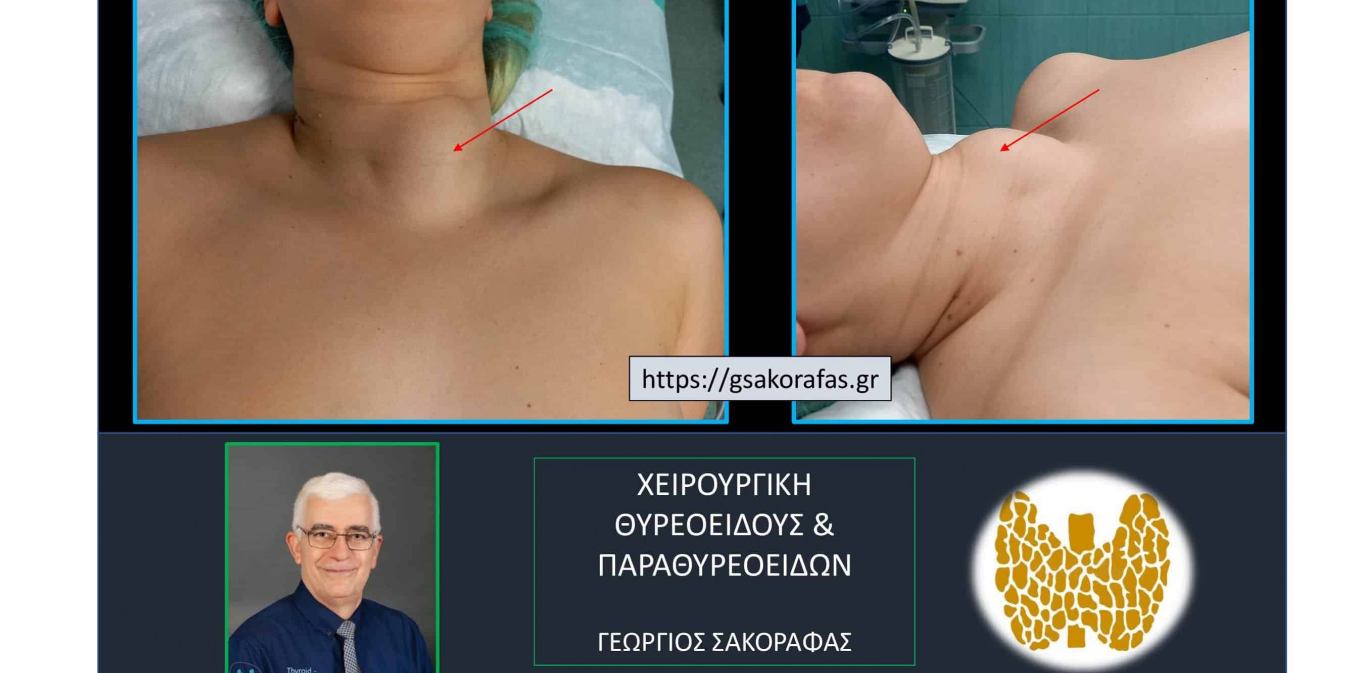 Λίαν ευμεγέθης όζος θυρεοειδούς σε νεαρή ασθενή μας (εικόνες)