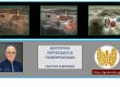 Αδένωμα παραθυρεοειδούς - υπερηχογραφικά ευρήματα