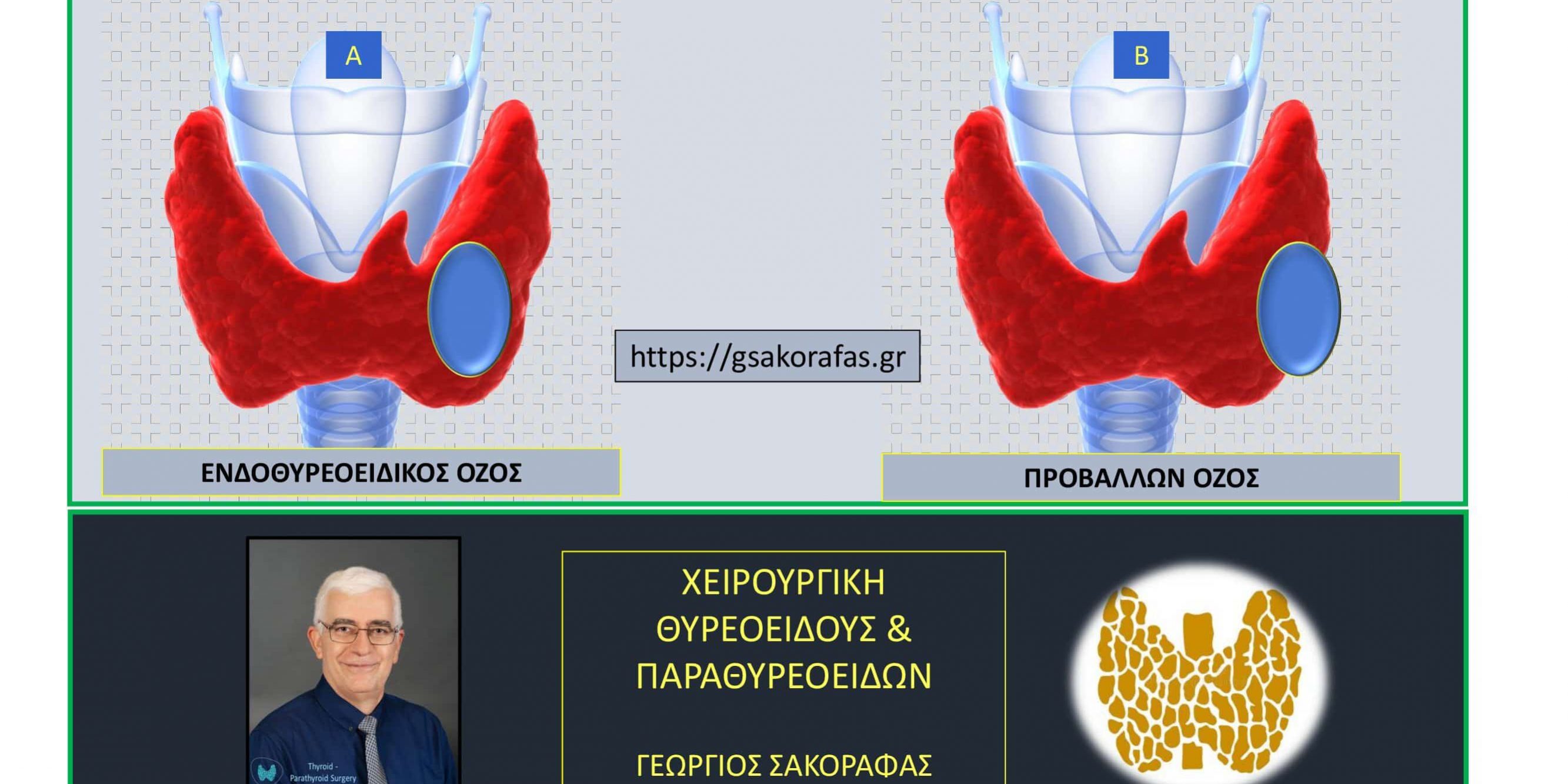 Όζοι θυρεοειδούς -ταξινόμηση-ενδοθυρεοειδικοί -προβάλλοντες