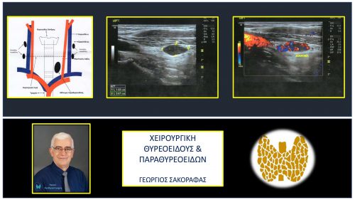 Αδένωμα παραθυρεοειδούς και θυρεοειδεκτομή (προηγηθείσα)-υπερηχογραφικά ευρήματα (βλ. κείμενο)
