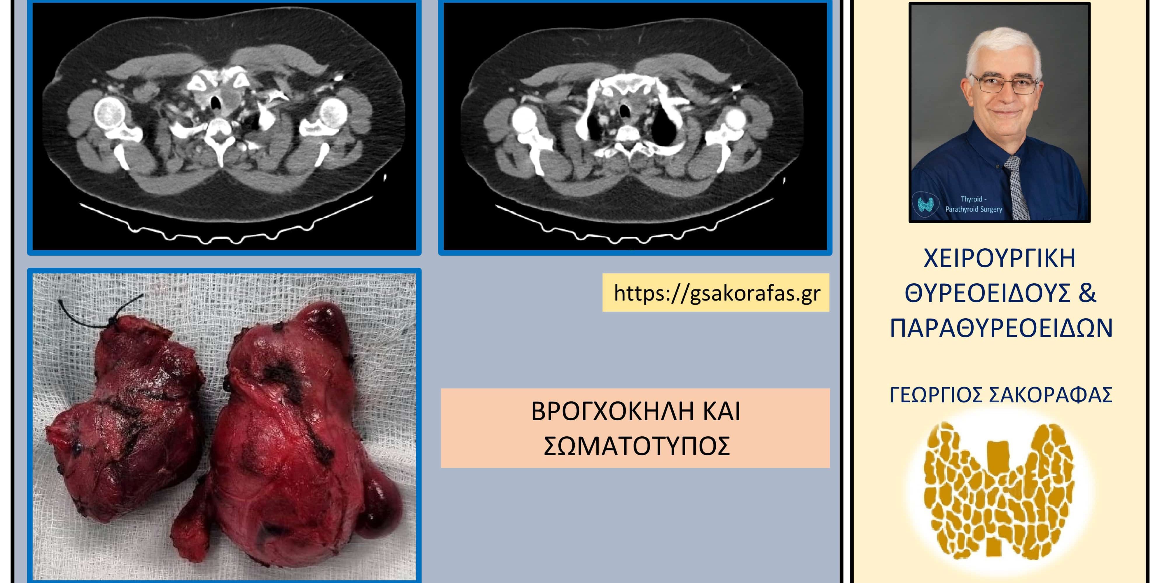 Βρογχοκήλη και σωματότυπος 861