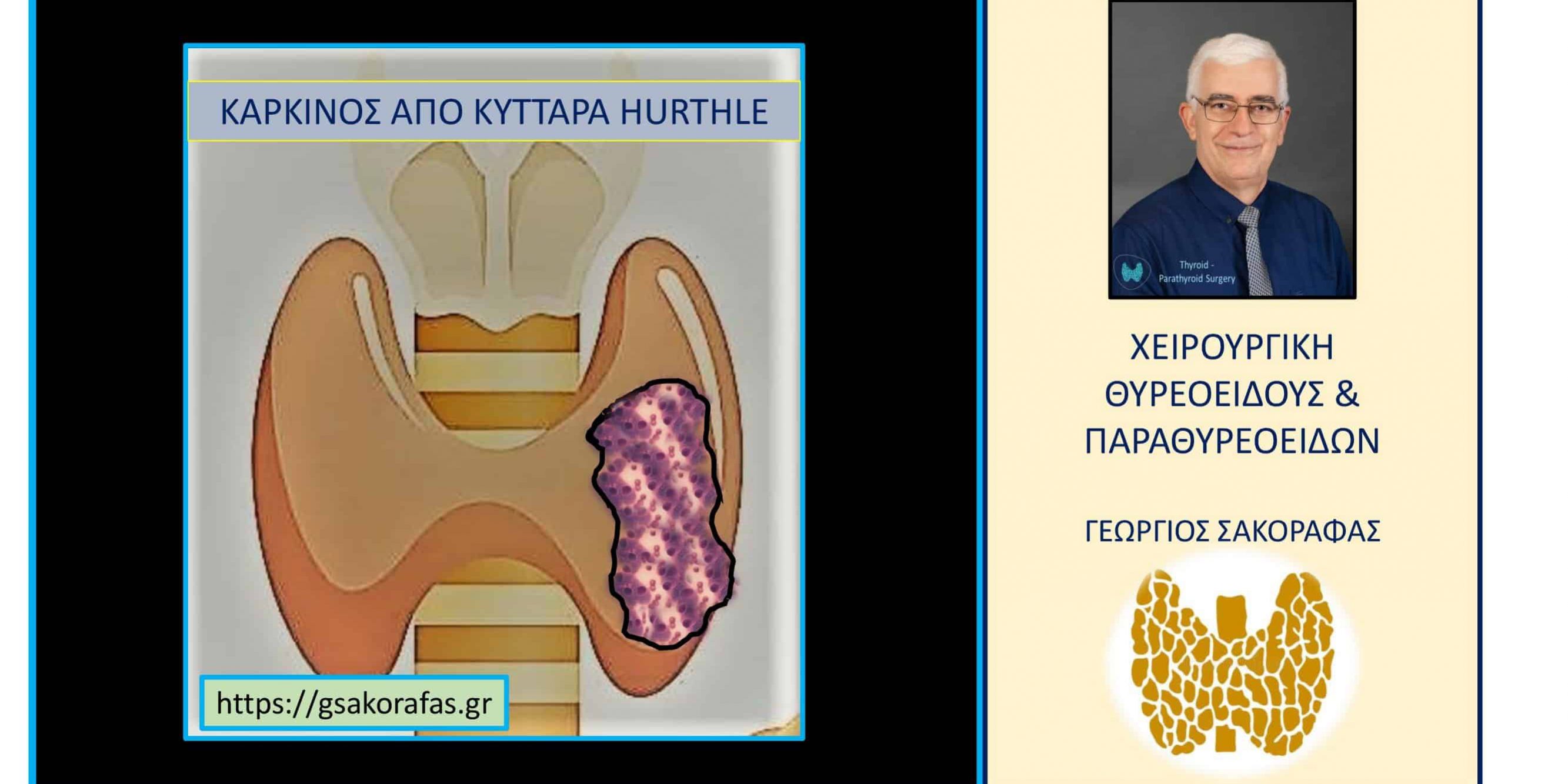 Καρκίνος θυρεοειδούς Hürthle cell (από κύτταρα Hürthle) 905