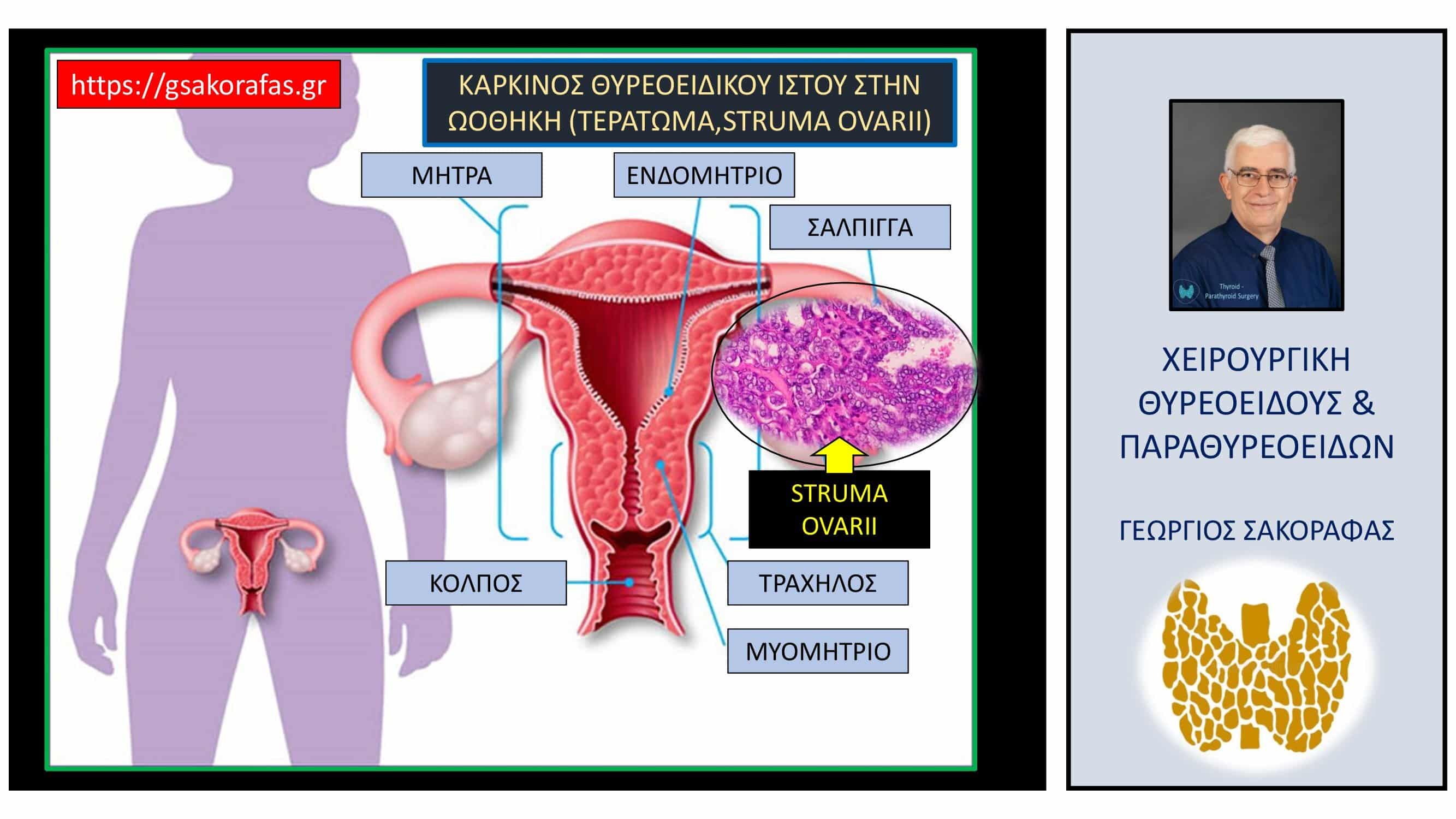 Έκτοπος καρκίνος θυρεοειδούς (ωοθήκη)– ανάπτυξη καρκίνου θυρεοειδούς σε έκτοπο θυρεοειδικό ιστό στην ωοθήκη (με αφορμή ασθενή μας)