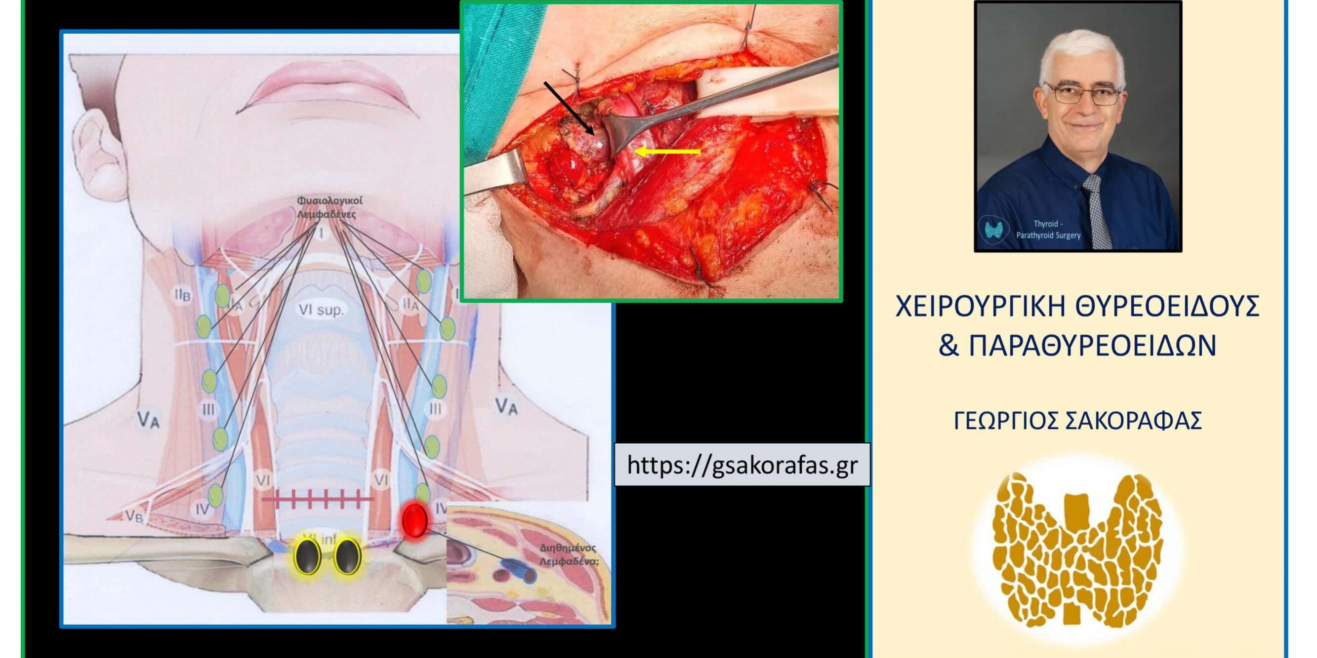 Καρκίνος θυρεοειδούς όψιμη υποτροπή 807