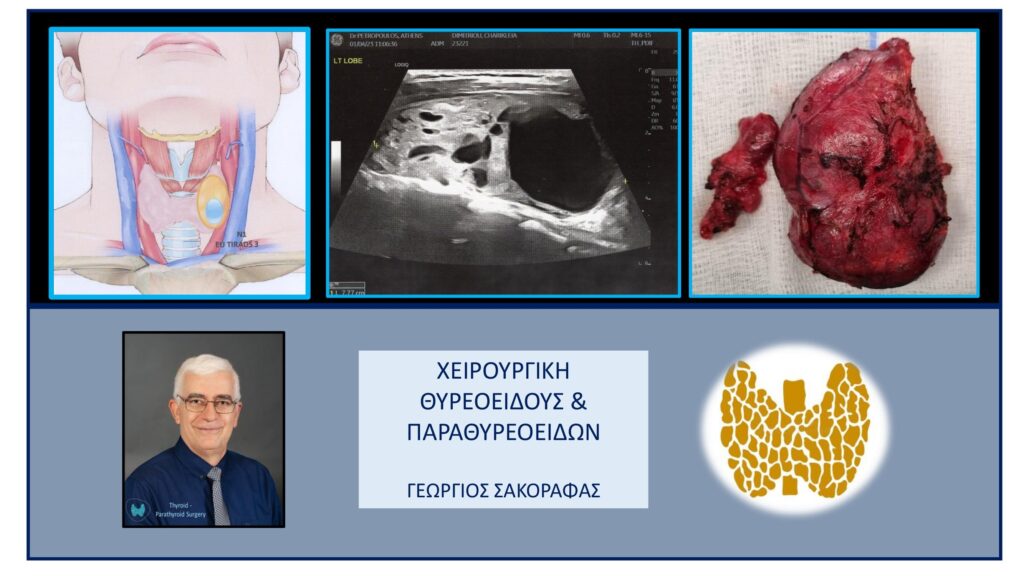 Γιγάντιο τοξικό αδένωμα θυρεοειδούς – με αφορμή ασθενή μας