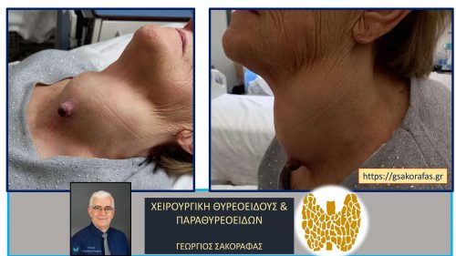Προεγχειρητική εικόνα της ασθενούς μας