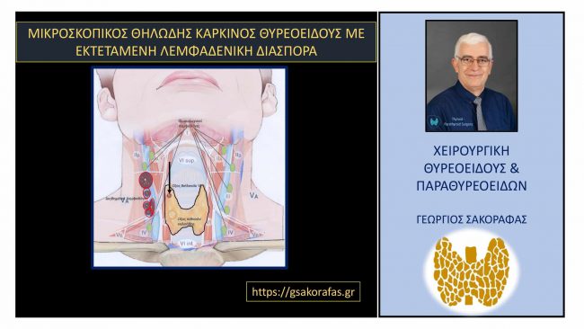 Μικροσκοπικός καρκίνος θυρεοειδούς (θηλώδης) με εκτεταμένη λεμφαδενική διασπορά 905