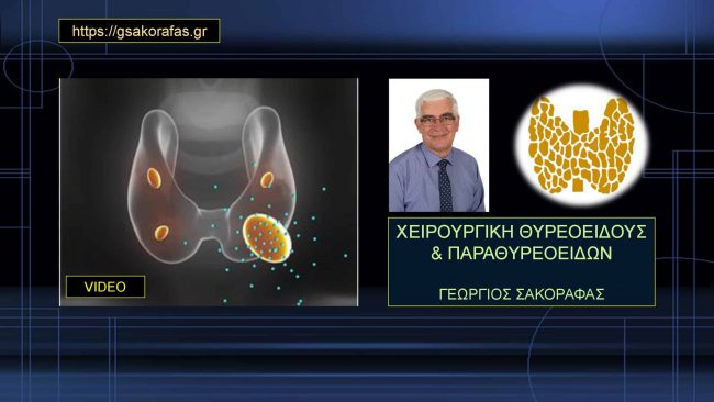 Θυρεοειδεκτομή και παραθυρεοειδείς vid-1 αναγνώριση και διατήρηση αριστερού άνω παραθυρεοειδούς σε ασθενή μας σε ολική θυρεοειδεκτομή