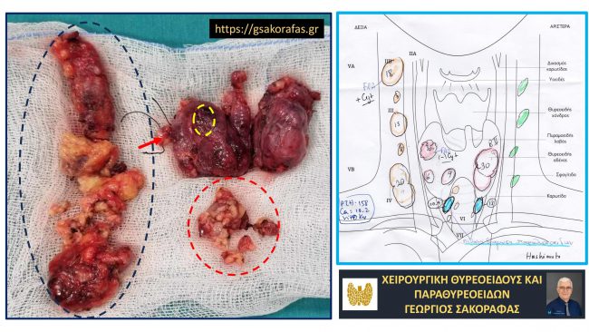 Συνδυασμένη θυρεοειδεκτομή, λεμφαδενικός καθαρισμός τραχήλου και παραθυρεοειδεκτομή σε ασθενή με καρκίνο θυρεοειδούς, εκτεταμένες λεμφαδενικές μεταστάσεις και υπερπαραθυρεοειδισμό.