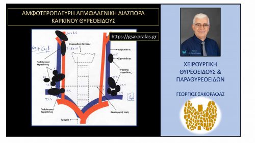 Χαρτογράφηση λεμφαδένων τραχήλου στην ασθενή μας