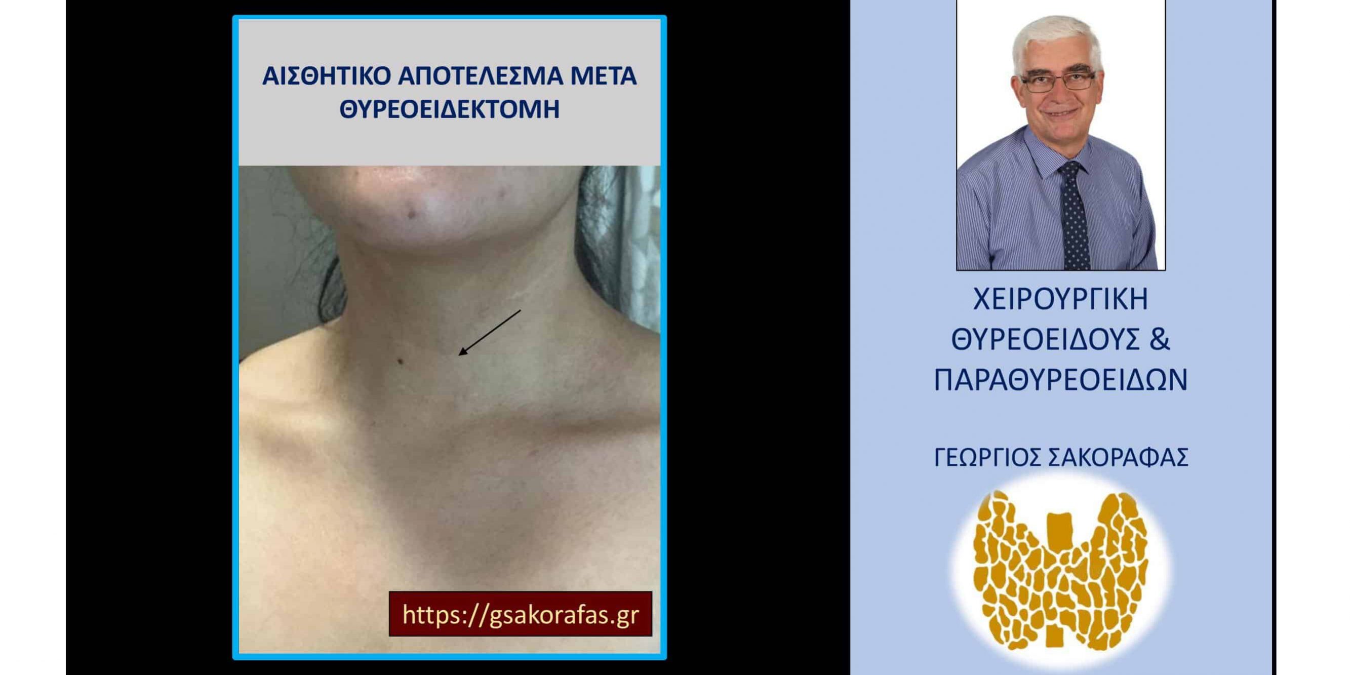 Θυρεοειδεκτομή αισθητικό αποτέλεσμα