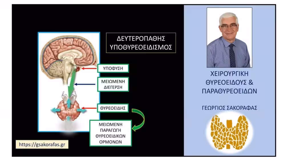 Δευτεροπαθής Υποθυρεοειδισμός 1– Ορισμός, Αιτιολογία, Κλινικές Εκδηλώσεις