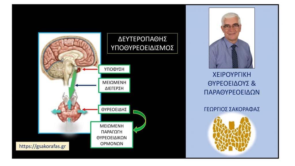 Δευτεροπαθής υποθυρεοειδισμός 1– ορισμός, αιτιολογία, κλινικές εκδηλώσεις Δευτεροπαθής υποθυρεοειδισμός 1– ορισμός, αιτιολογία, κλινικές εκδηλώσεις