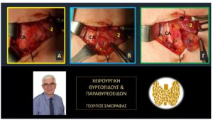Ευρήματα στη διάρκεια της επέμβασης. 1=αδένωμα παραθυρεοειδούς 2=δεξιός λοβός θυρεοειδούς CCA=κοινή καρωτίδα αρτηρία (Α). Το αδένωμα μόλις έχει αναγνωριστεί στην εν τω βάθει θέση του, πίσω και επί τα εντός της δεξιάς κοινής καρωτίδας (Β). Έχει ήδη αρχίσει η παρασκευή και η κινητοποίηση του αδενώματος (Γ). Η κινητοποίηση του αδενώματος έχει ολοκληρωθεί και το αδένωμα είναι έτοιμο να αφαιρεθεί.
