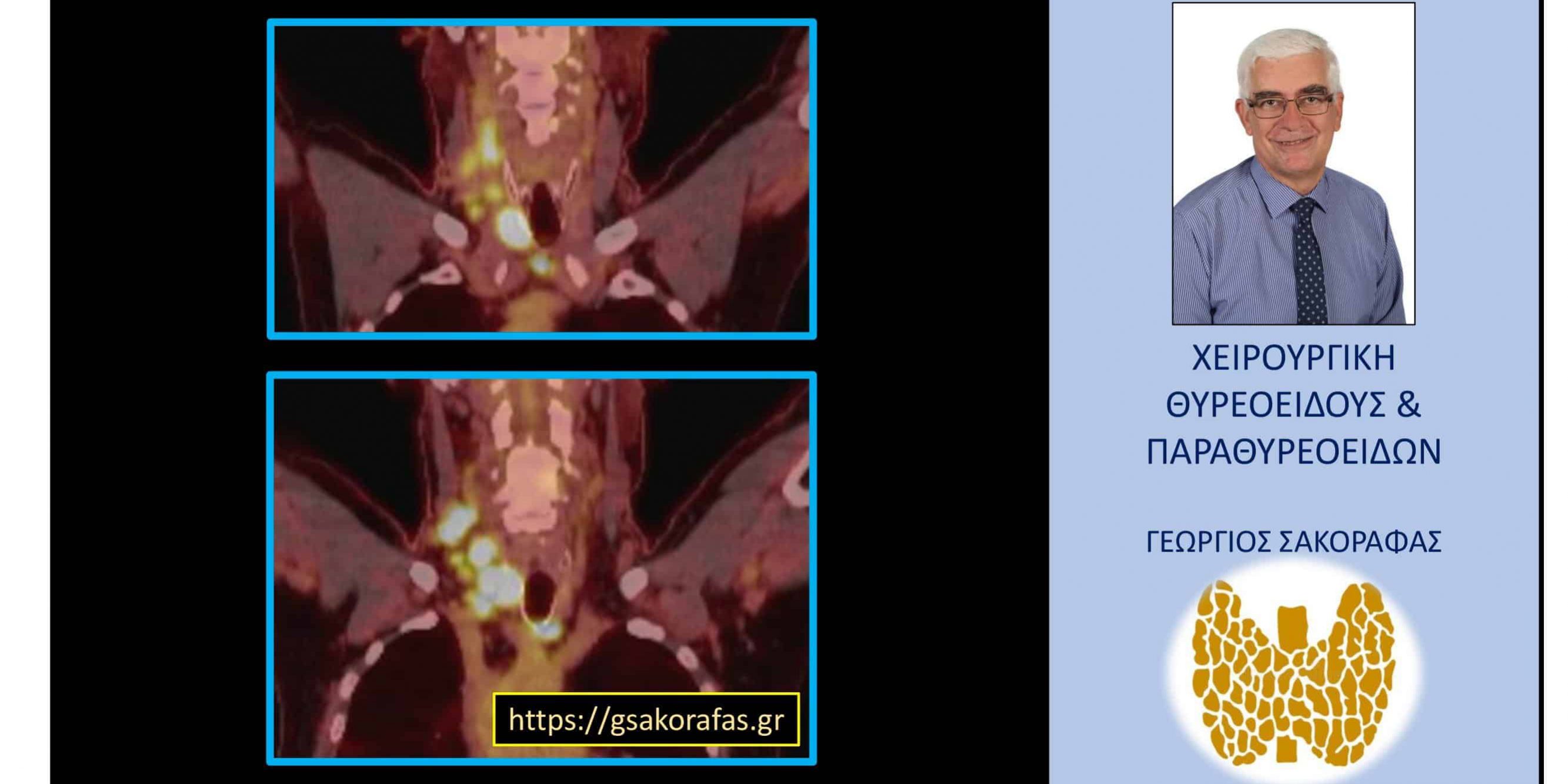Καρκίνος θυρεοειδούς με εκτεταμένη λεμφαδενική διασπορά σαν τυχαίο εύρημα σε τομογραφία εκπομπής ποζιτρονίων σε ασθενή με άλλη πάθηση (οζώδης σκίαση πνεύμονα)