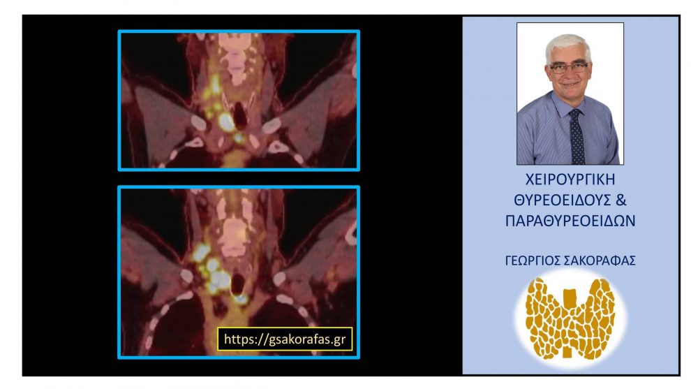 Καρκίνος θυρεοειδούς με εκτεταμένη λεμφαδενική διασπορά σαν τυχαίο εύρημα σε τομογραφία εκπομπής ποζιτρονίων σε ασθενή με άλλη πάθηση (οζώδης σκίαση πνεύμονα)