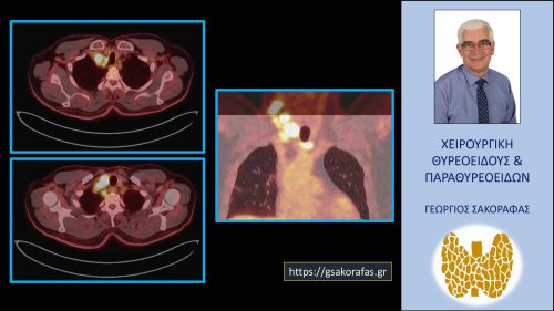 Ευρήματα στο PET-CT scan (;άλλες τομές)