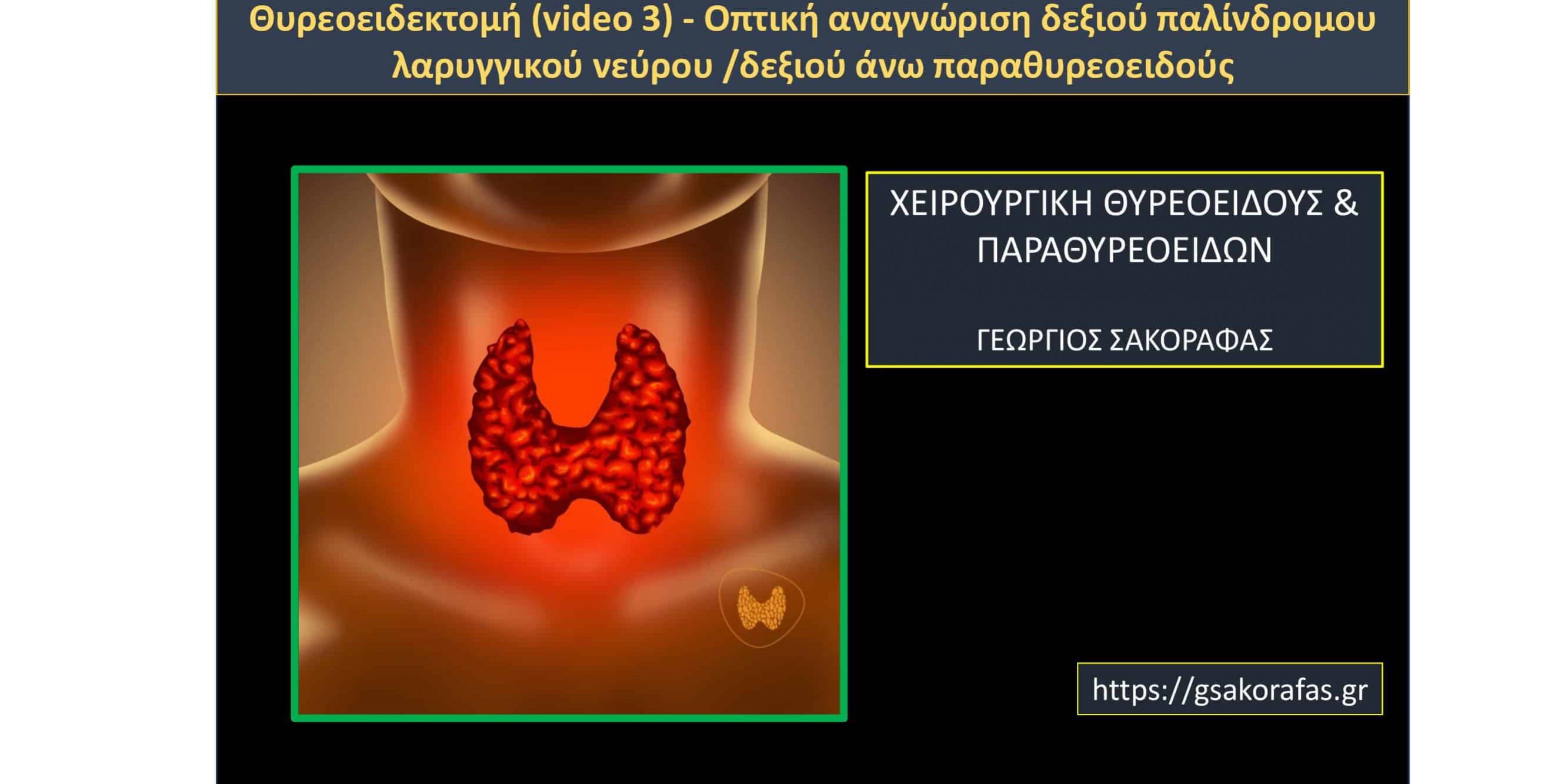 Θυρεοειδεκτομή (video 3) - Οπτική αναγνώριση δεξιού παλίνδρομου λαρυγγικού νεύρου /δεξιού άνω παραθυρεοειδούς
