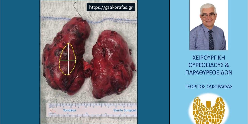 Γιγάντια τοξική βρογχοκήλη