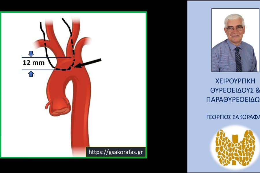 Όζος θυρεοειδούς καταδυόμενος σε βάθος μέχρι κάτωθεν του αορτικού τόξου– αφαίρεση μέσω τραχηλικής τομής σε ασθενή μας