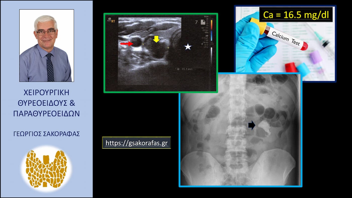 Υπερασβεστιαιμική κρίση και υπερπαραθυρεοειδισμός (εξαιρετικά βαριά υπερασβεστιαιμία) σε ασθενή μας: μία δυνητικά θανατηφόρα επιπλοκή του υπερπαραθυρεοειδισμού