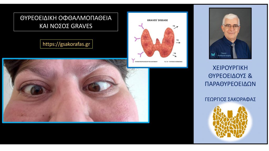 Θυρεοειδική οφθαλμοπάθεια – με αφορμή ασθενή μας (εικόνα) Θυρεοειδική οφθαλμοπάθεια – με αφορμή ασθενή μας (εικόνα)