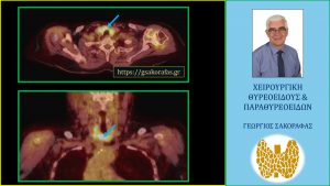 Όζοι θυρεοειδούς και PET scan – με αφορμή υπερήλικα ασθενή μας