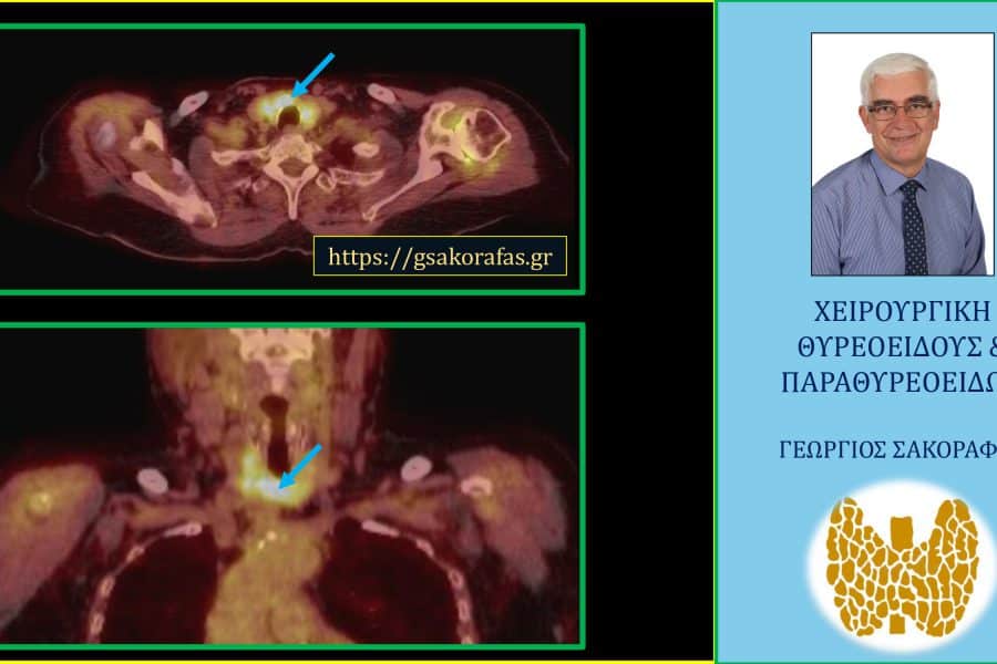 Όζοι θυρεοειδούς και PET scan – με αφορμή υπερήλικα ασθενή μας