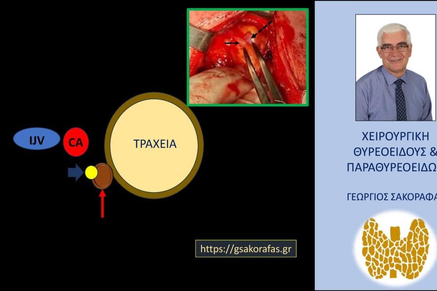 Θυρεοειδεκτομή παραθυρεοειδεκτομή : συνδυασμένη επέμβαση σε ασθενή μας με ‘δύσκολη’ θέση του αδενώματος παραθυρεοειδούς.