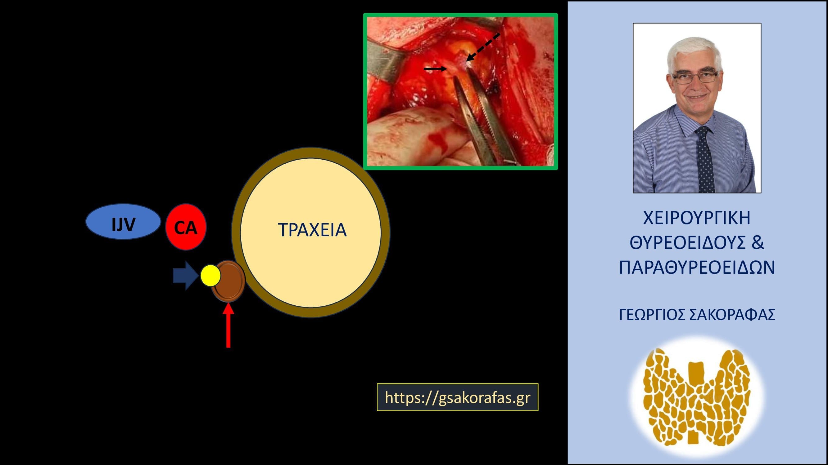 Θυρεοειδεκτομή παραθυρεοειδεκτομή : συνδυασμένη επέμβαση σε ασθενή μας με ‘δύσκολη’ θέση του αδενώματος παραθυρεοειδούς.