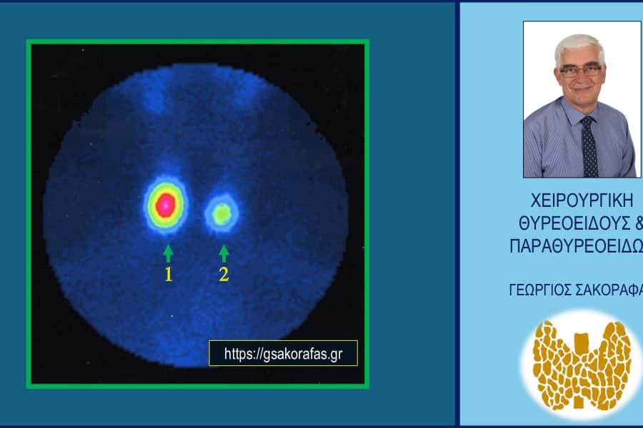 Θερμός όζος θυρεοειδούς – με αφορμή ασθενή μας