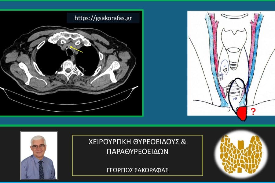 Καταδυόμενος όζος θυρεοειδούς – Εικόνες (σε ασθενή μας)