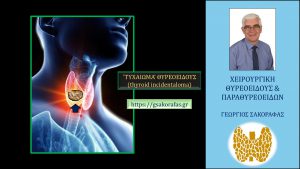 Τυχαίωμα θυρεοειδούς (thyroid incidentaloma) – Τι είναι? Πώς αντιμετωπίζεται?