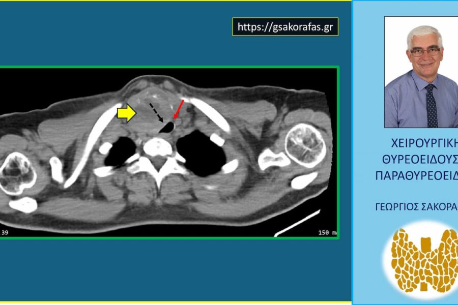Γιγάντιος όζος θυρεοειδούς