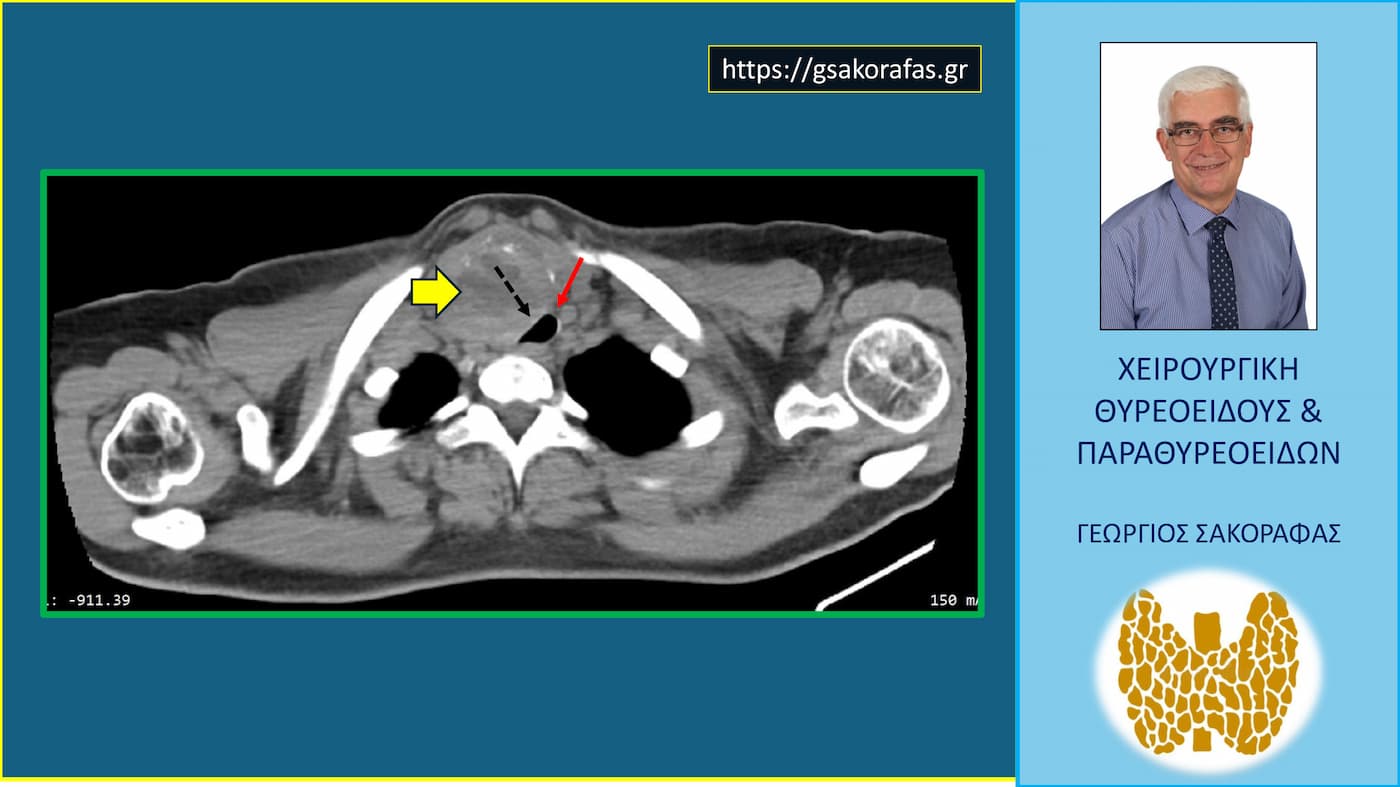 Γιγάντιος όζος θυρεοειδούς με κατάδυση στο μεσοθωράκιο σε νεαρή ασθενή μας – εικόνες