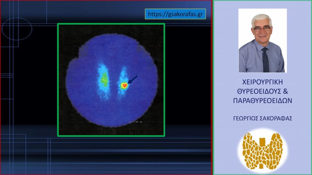 Θερμός όζος θυρεοειδούς