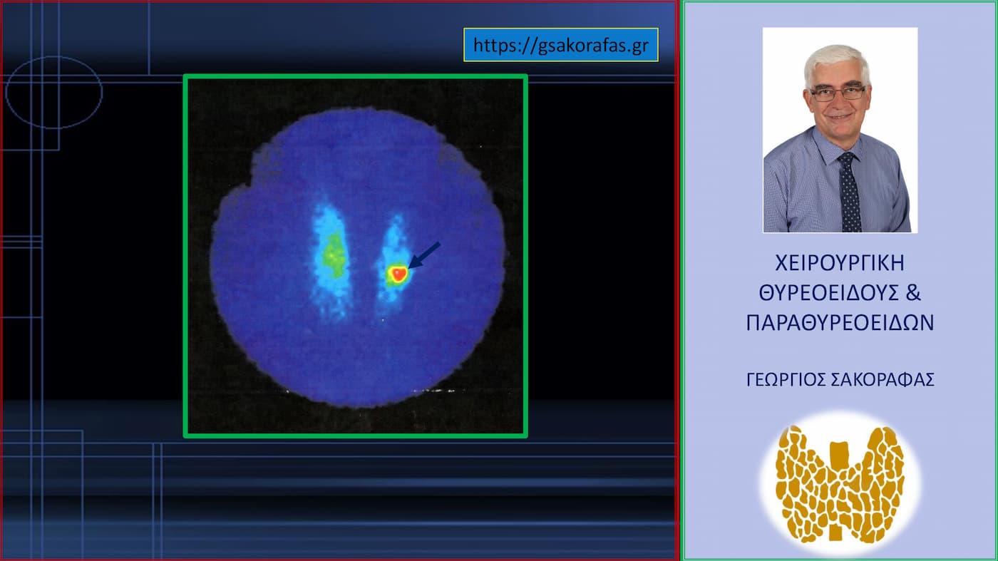 Θερμός όζος θυρεοειδούς – αυτόνομο τοξικό αδένωμα μερικώς αντιρροπούμενο (Εικόνα)