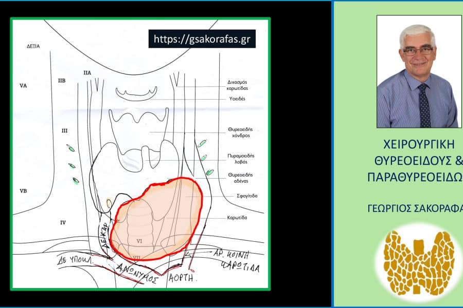 Όζος θυρεοειδούς, γιγάντιος, βαθιά καταδυόμενος -σχηματική αναπαράσταση των ευρημάτων στο υπερηχογράφημα