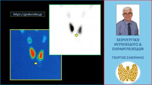 Ψυχρός Όζος Θυρεοειδούς – Μία Όλο Και Πιο Σπάνια Σήμερα Εικόνα (Με Αφορμή Ασθενή Μας)