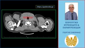 Γιγάντια Τοξική Βρογχοκήλη - Εμφανής Στην Αξονική Τομογραφία Η Πλήρης Πρακτικά Κατάληψη Ολόκληρου Του Τραχήλου Από Τον Λίαν Ευμεγέθη Θυρεοειδή Αδένα